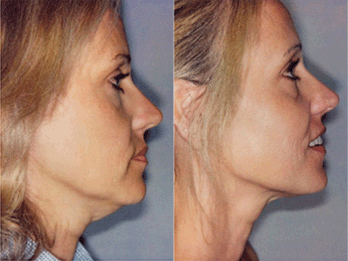 Thermage Caso 1