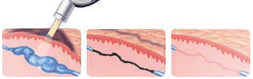 Flebologia Laser IPL
