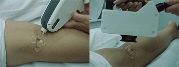 Laser Varices